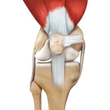 Medial Patellofemoral Ligament (MPFL) Tears Raleigh | MPFL Injury Cary NC