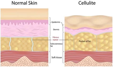 Cellulite Treatment in NYC | Manhattan Dermatology Specialists