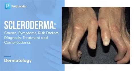 Scleroderma: Causes, Symptoms, Risk Factors, Diagnosis, Treatment and ...