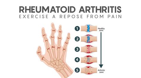 Rheumatoid Arthritis: Exercise-A repose from pain.