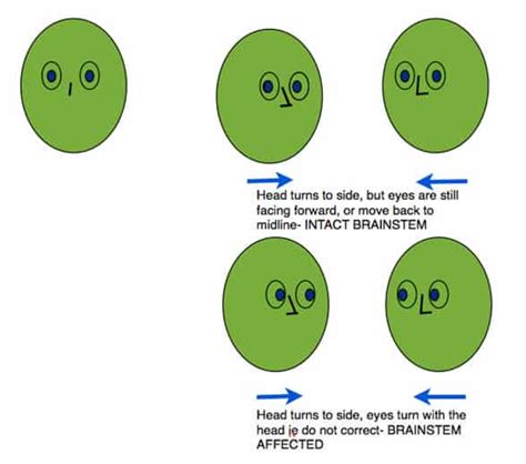 Doll's Eyes and Brainstem Stroke | Resus