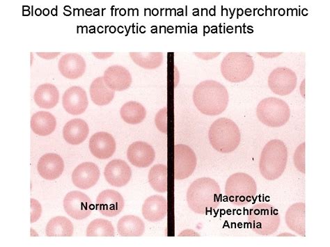 Blood Erythrocytes RBC Blood Smear with Erythrocytes Red