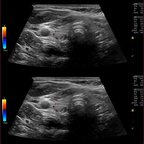 Ultrasound neck showing normal thyroid gland and no abnormal ...