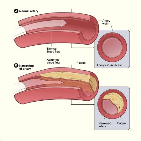 Qu'est-ce que l'athérosclérose ? Symptômes de l'athérosclérose - Fmedic