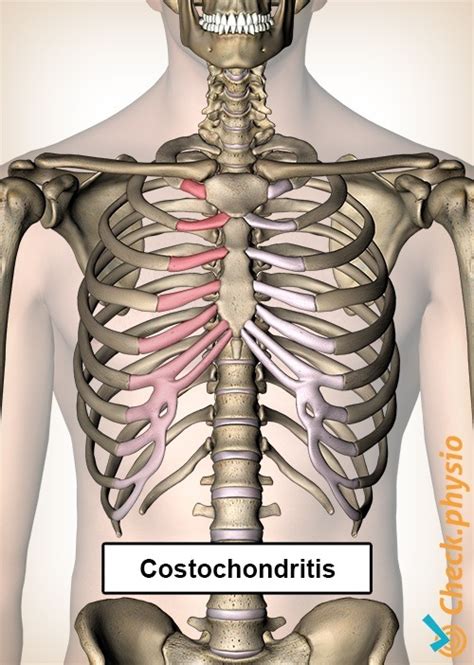 Costochondritis | Physio Check