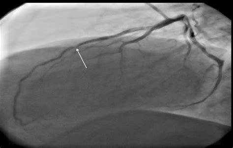 In-stent restenosis in proximal part of previous stent in LAD ...