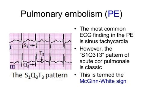 Prepare for Medical Exams : Regarding the most common ECG finding of ...