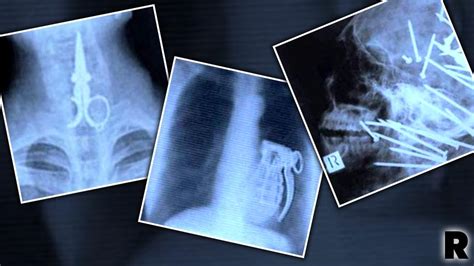 Inside Story! Weird Objects & Horrifying Injuries Caught On X-Ray!