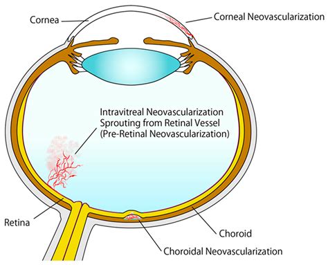 Retinal Neovascularization