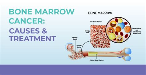 Bone Marrow Cancer: Causes And Treatment | MrMed