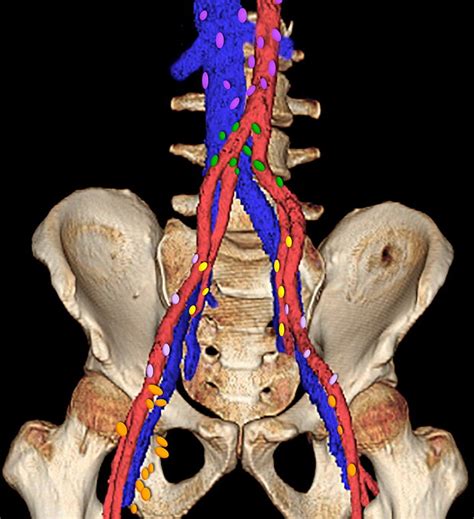 Internal Iliac Lymph Nodes