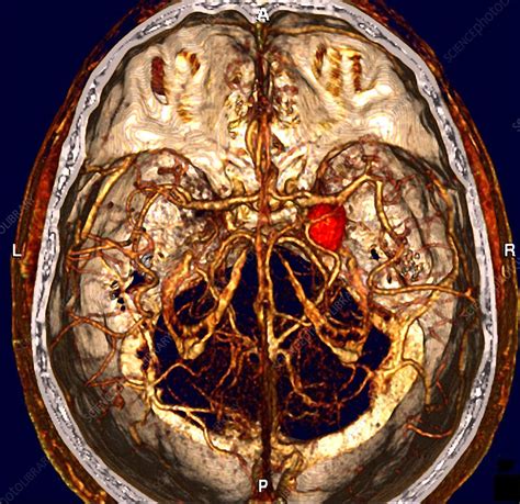 Cerebral aneurysm, CT scan - Stock Image - M136/0212 - Science Photo ...