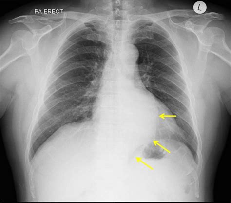 Thoracic Aortic Aneurysm Chest X Ray