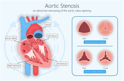 Aortic Valve Stenosis Symptoms and Treatment in Hyderabad