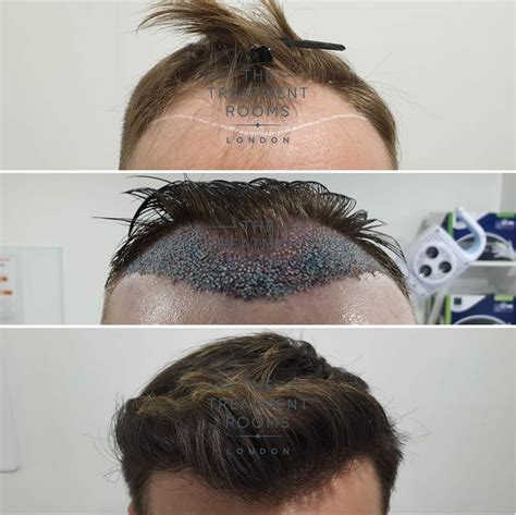 Receding Hairline Transplant Cost in London | Treatment Rooms London