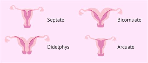 How Rare Is Septate Uterus