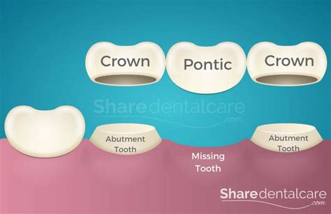 Dental Bridge: Types, and How the Procedure Is Done - Share Dental Care