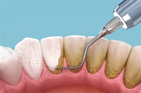 5 Tips to (Safely) Remove Plaque From Teeth