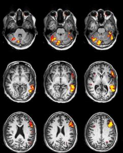 Difference between MRI and fMRI