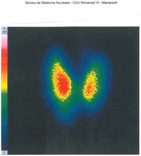 A thyroid image obtained for patient 1 by using a gamma camera type ...