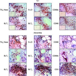 Immunolocalization of the leukotriene pathway in AAAs.... | Download ...