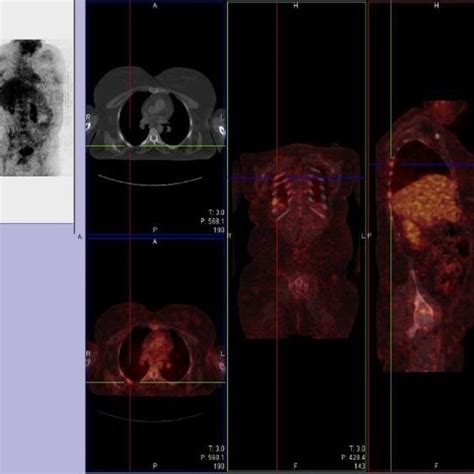 PET-scan for differential diagnosis of lymphoma reveals increased ...