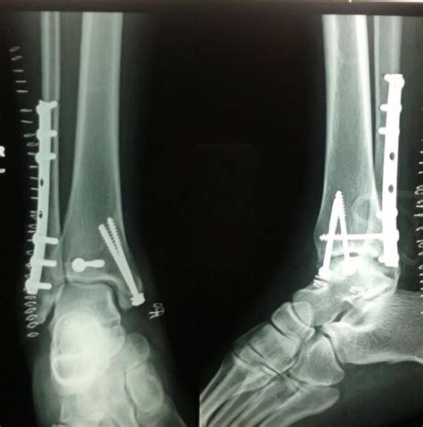 Posterior Malleolus Fracture with Dislocation — OrthopaedicPrinciples.com