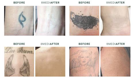 Tattoo Removal Treatment Treatment