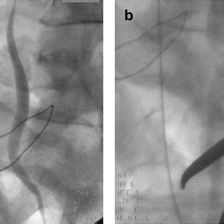 a, 4b. Retrograde pyelogram done intraoperatively, showing a continuous ...