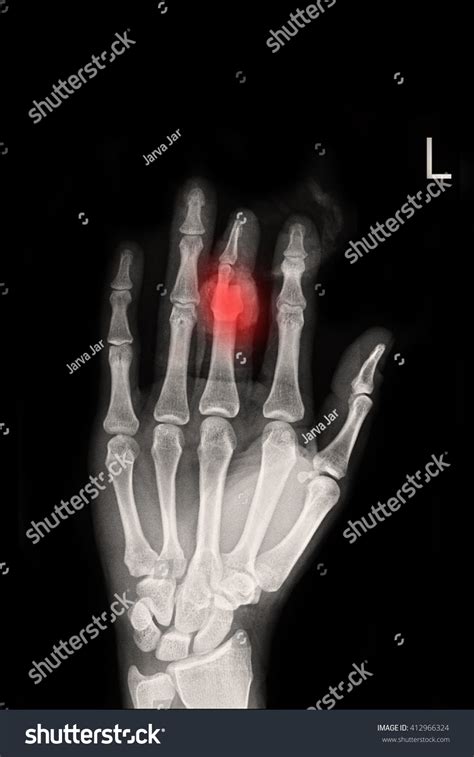 Fracture Middle Finger Left Hand Stock Photo 412966324 | Shutterstock