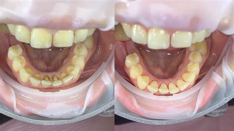 Teeth Cleaning with AIRFLOW® Prophylaxis Master - Gorbatov Dentistry