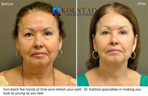 face lift results san diego 1 - Dr. Kolstad - San Diego Facial Plastic ...