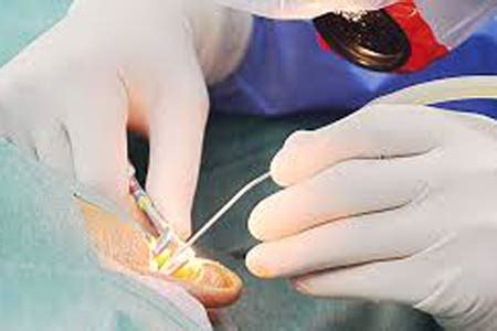 Stapedectomy Surgery in India: Causes, Procedure, Hospitals