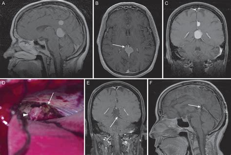 Surgical treatment of falcotentorial meningiomas: a retrospective ...