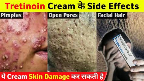 Tretinoin Cream के ये Side Effects आप नहीं जानते होगे 😱 - YouTube