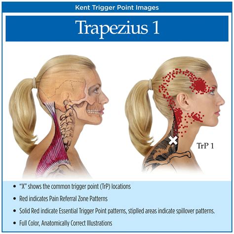 Trapezius Muscle Headache - Headache