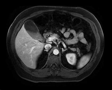 Gallbladder sludge - wikidoc