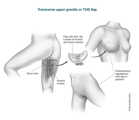 Flap Procedures | Breast Reconstruction Using Your Own Tissue ...