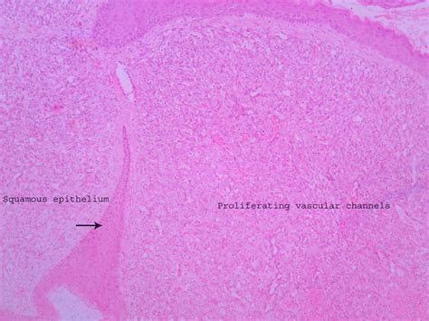 Capillary hemangioma – Histopathology.guru