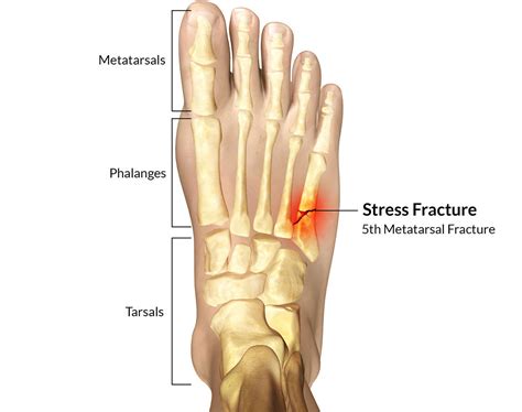 5th Metatarsal Fracture - Motus Physical Therapy