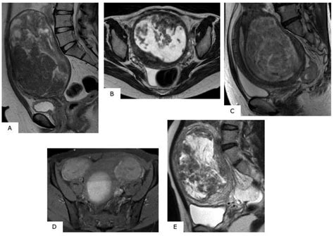 Healthcare | Free Full-Text | Differential Diagnosis of Uterine ...