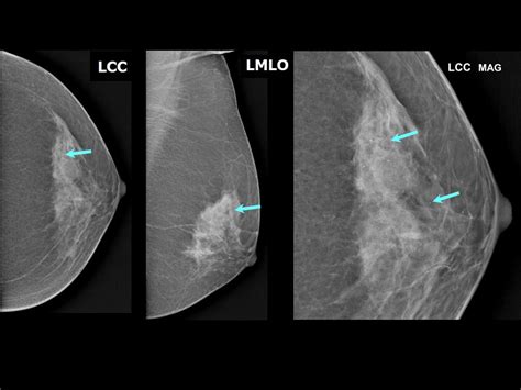 Atlas of breast cancer early detection