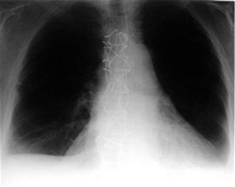 Sternum Wires & Heart Surgery - Sternal Wires