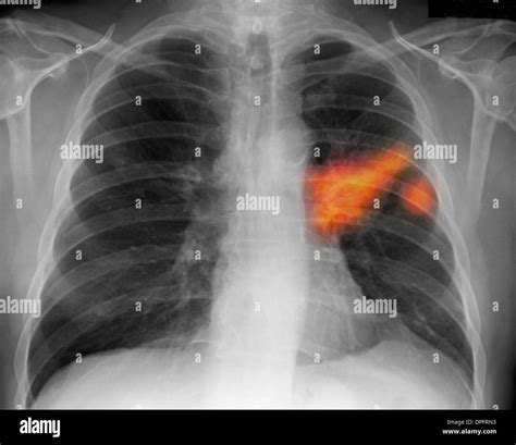 Chest x-ray of a smoker showing lung cancer Stock Photo: 65501439 - Alamy