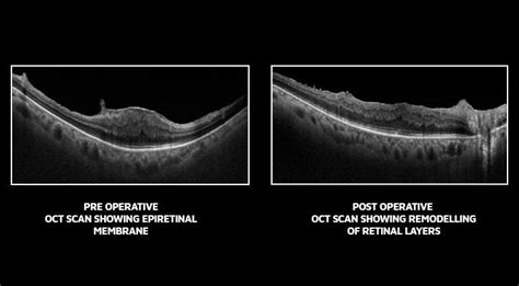 Epiretinal Membrane Symptoms Archives - Neoretina Blog