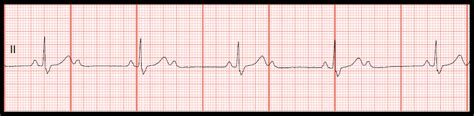 Float Nurse: Practice EKG Strips 399