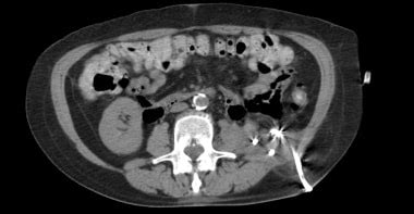 Perinephric Abscess Workup: Laboratory Studies, Imaging Studies