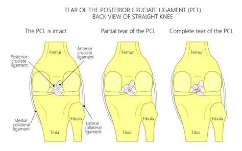 Grade 1 Acl Sprain