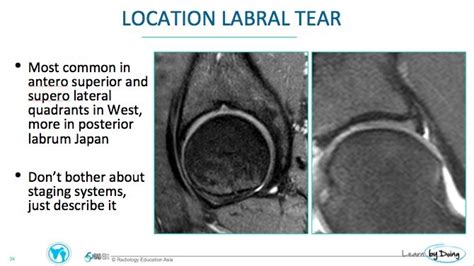 Labral Tear Hip MRI Images