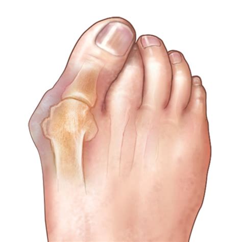 What Causes Bunions?